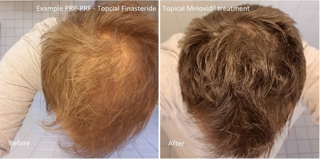 Finasteride In France