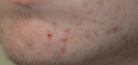 roaccutane avec ou sans ordonnance