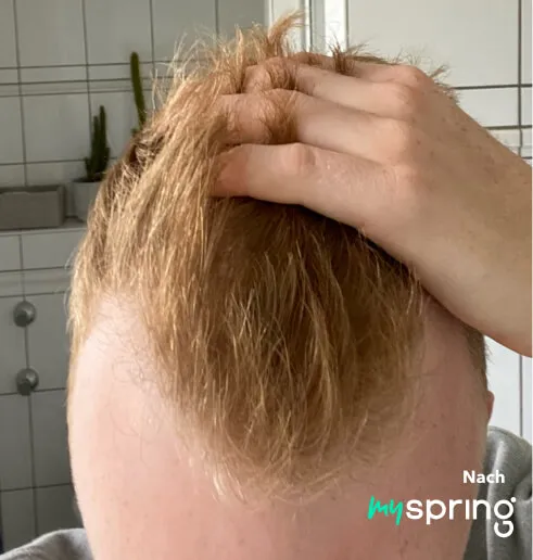Finasteride online europe