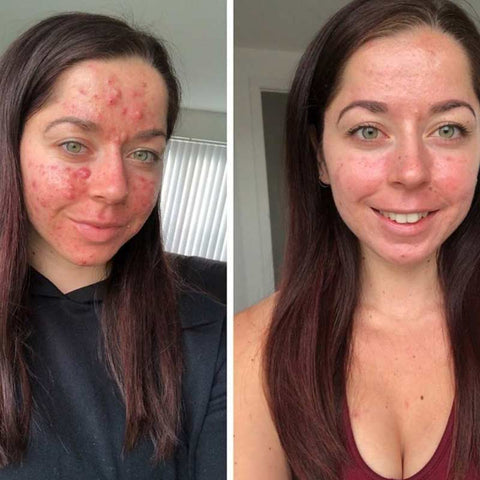 Comment acheter du accutane comment acheter du accutane