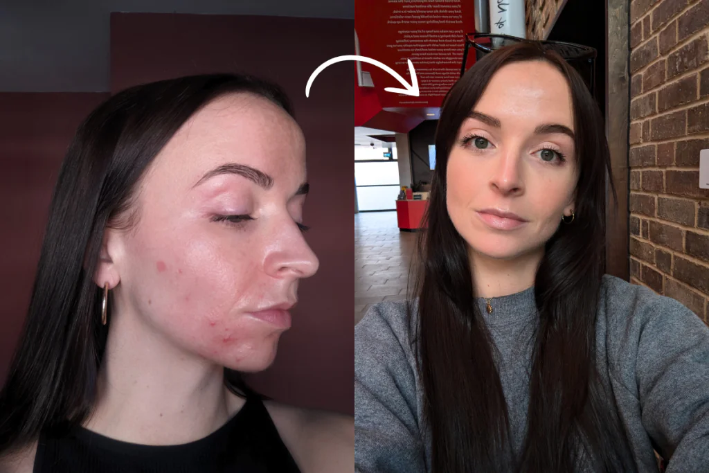 Accutane 40mg