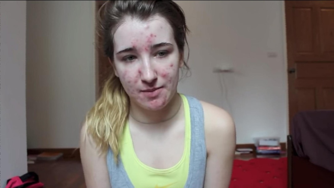 Accutane prix québec
