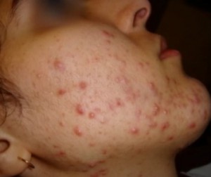 Isotretinoin pilules