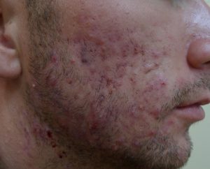 roaccutane gel prix