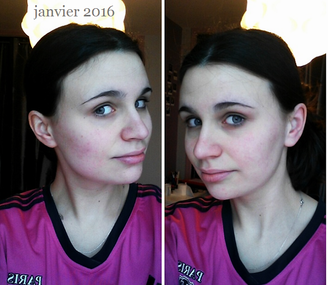 accutane 20mg