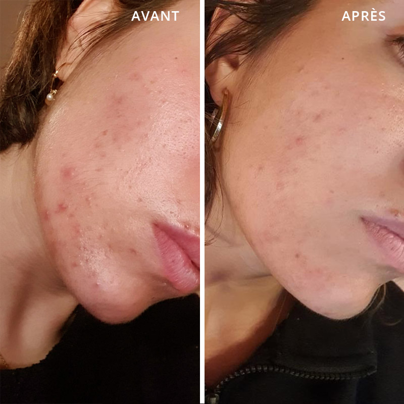 Prix roaccutane crème