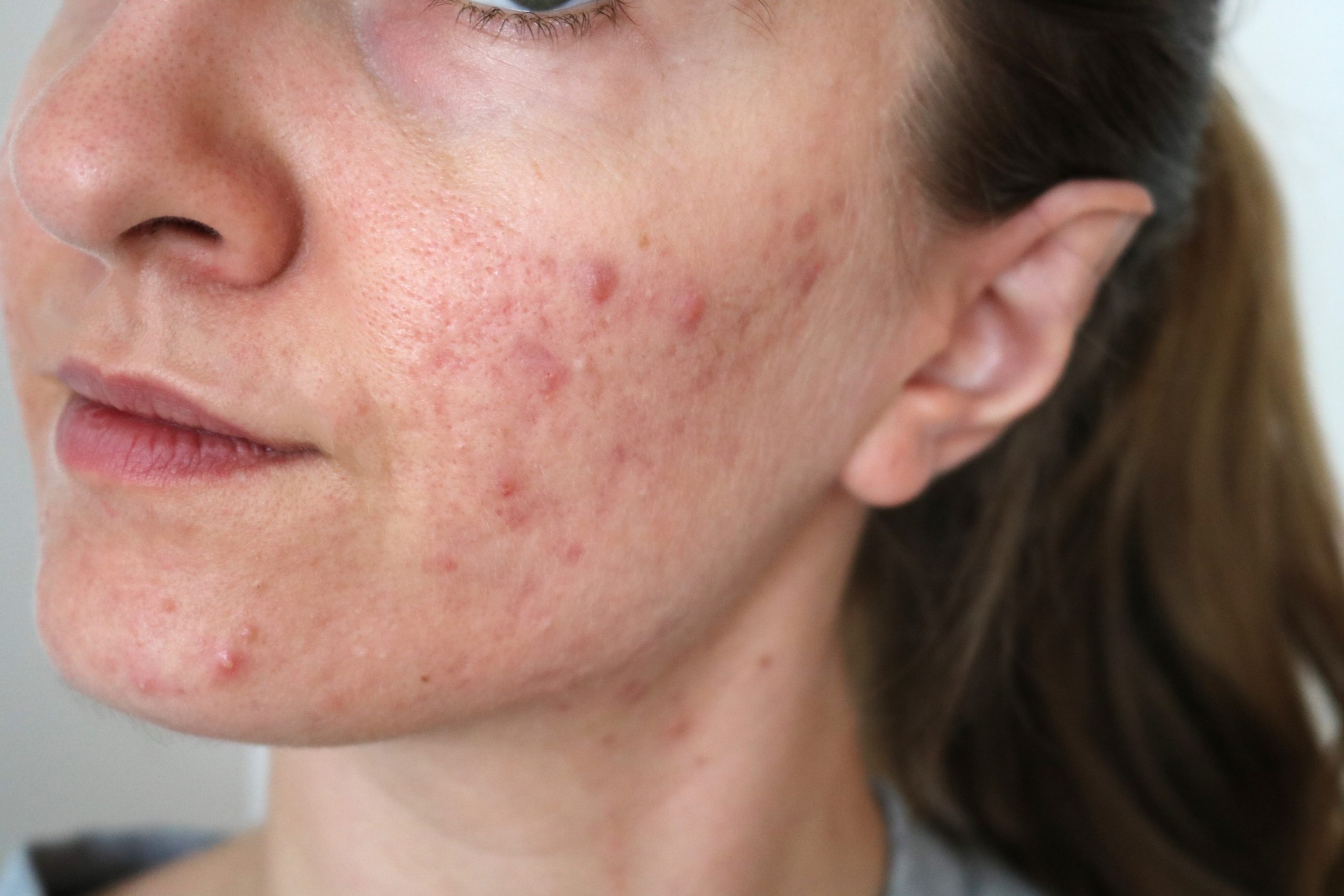 roaccutane ou pilule