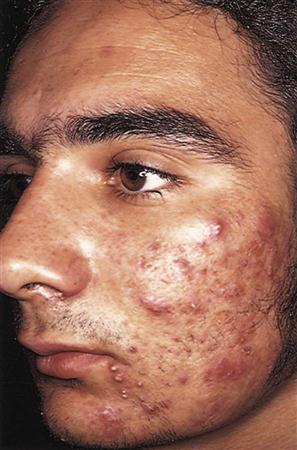 Coût Accutane