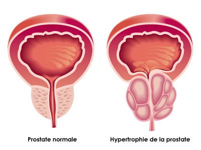 Finasteride prix belgique
