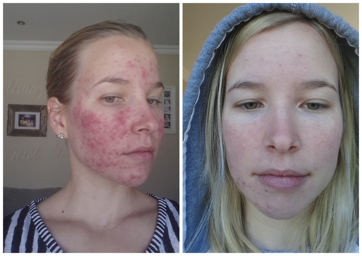 Où acheter du roaccutane