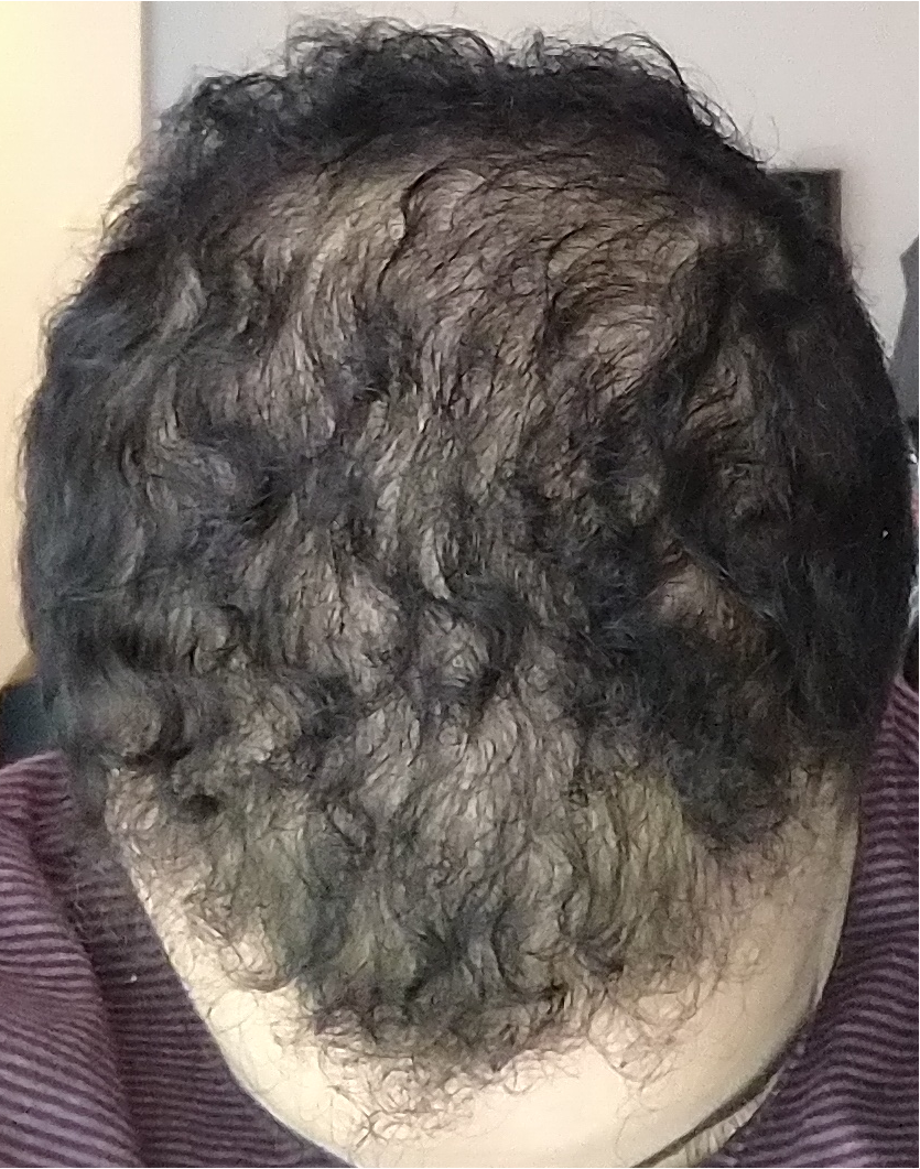 Finasteride Farmacia Online