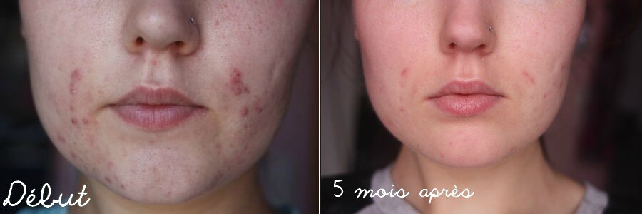 Roaccutane 40mg