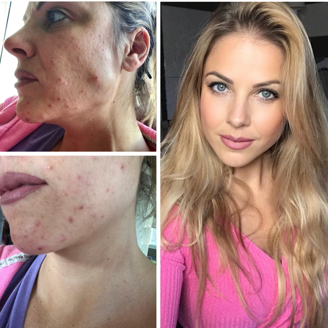 roaccutane sans pilule