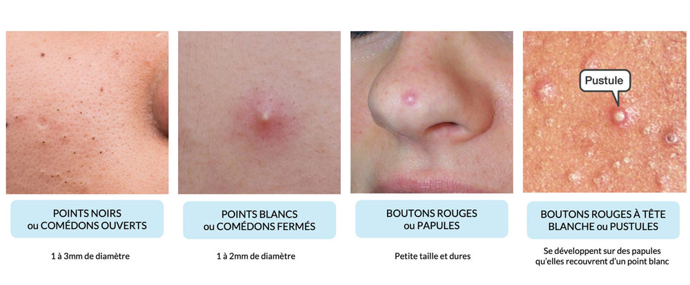 Roaccutane creme sans ordonnance