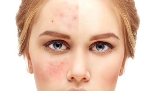 Roaccutane Prix Acné