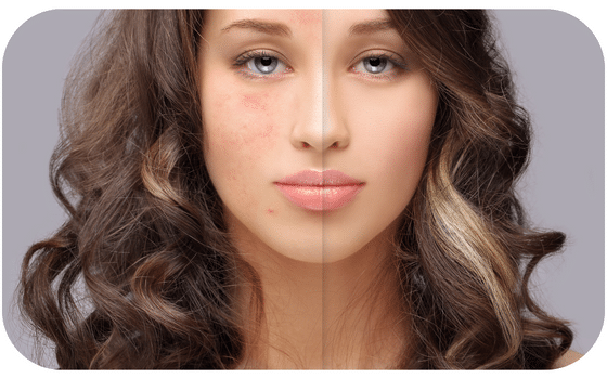 Accutane Prix Québec