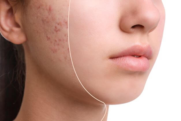 roaccutane online