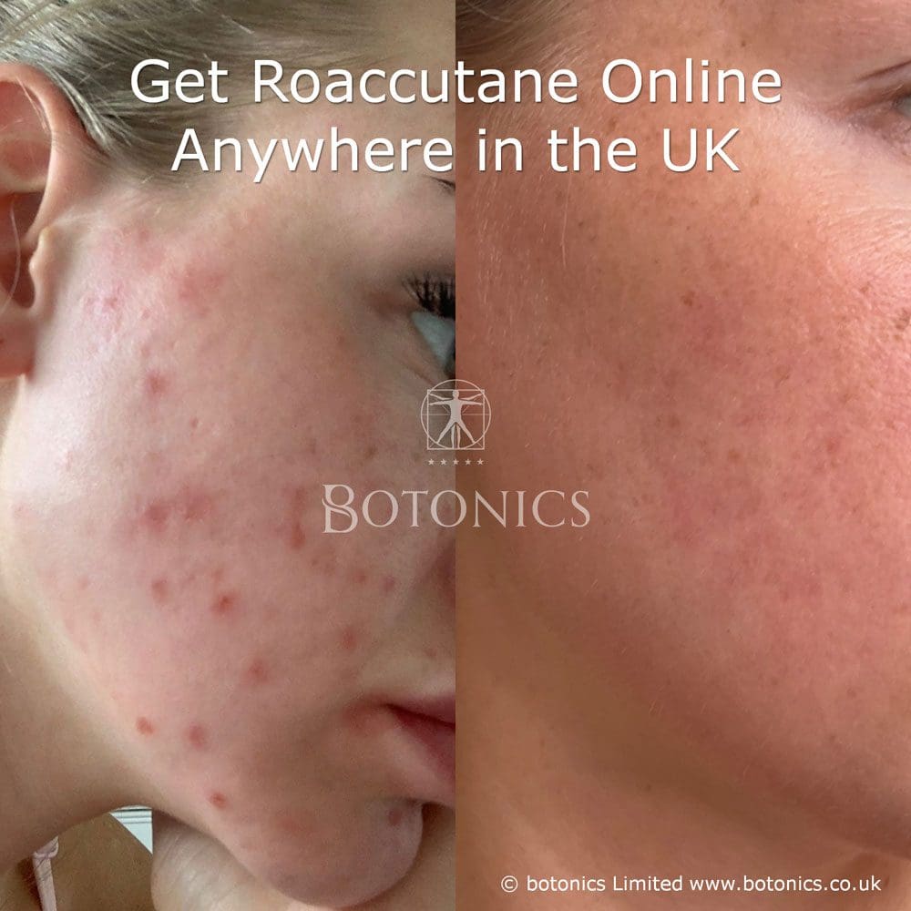 Accutane Acheter Online Accutane Acheter Online