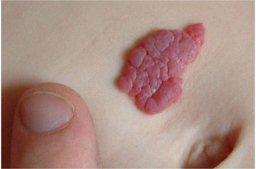 Propranolol 10 mg rcp