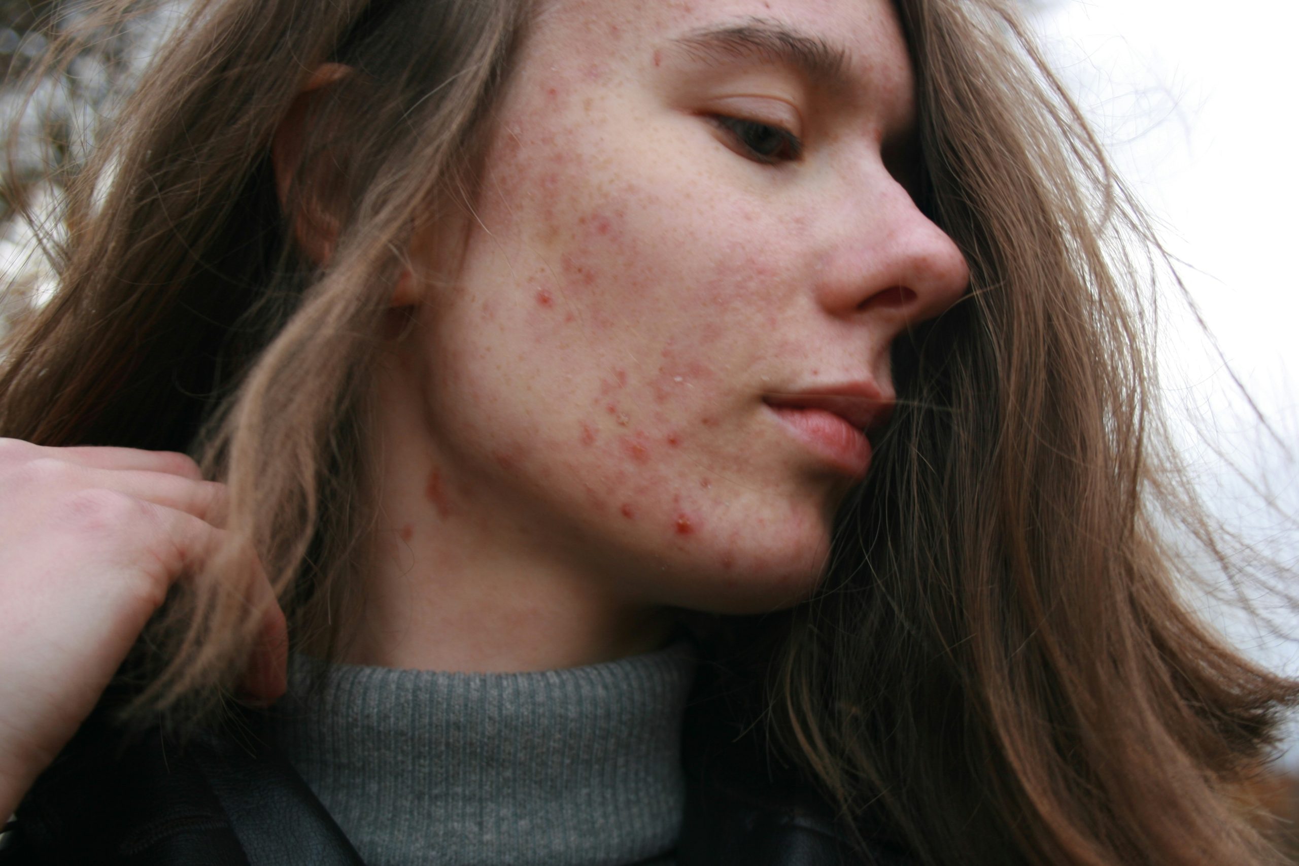 accutane en ligne