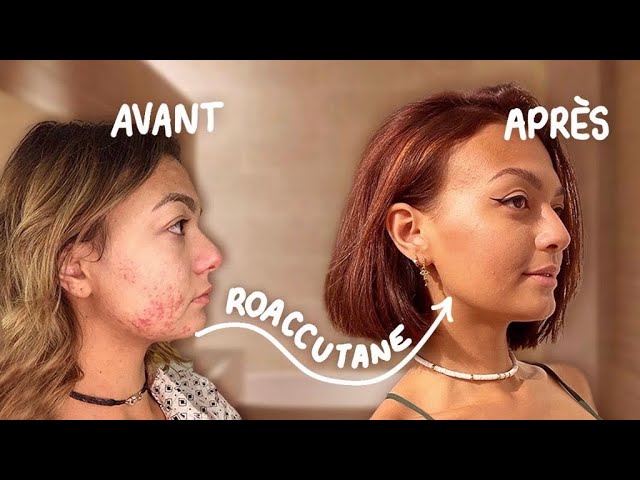 Accutane bon marché