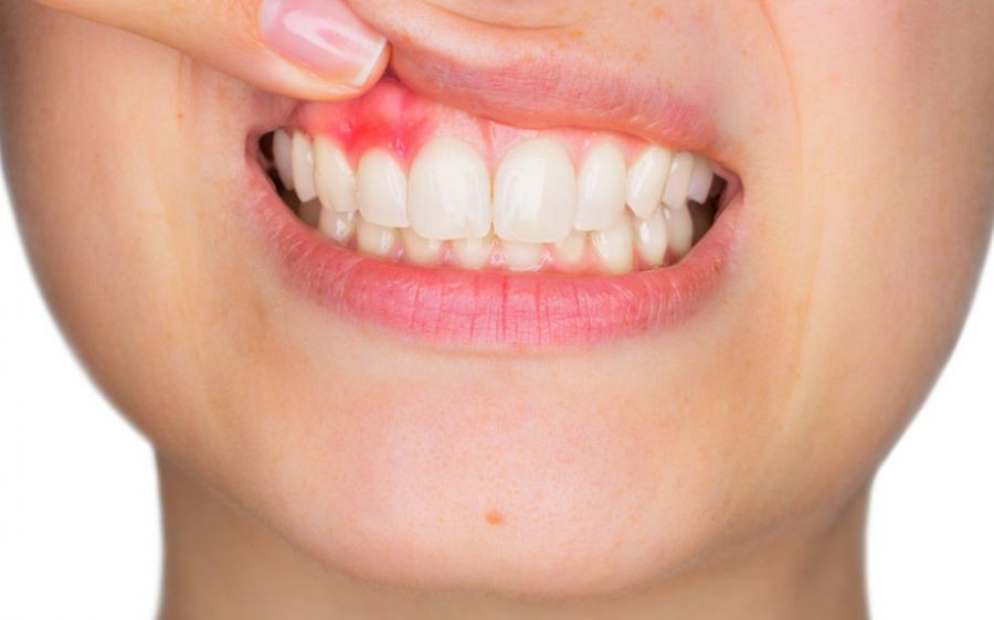 Amoxicilline Dent Sans Ordonnance