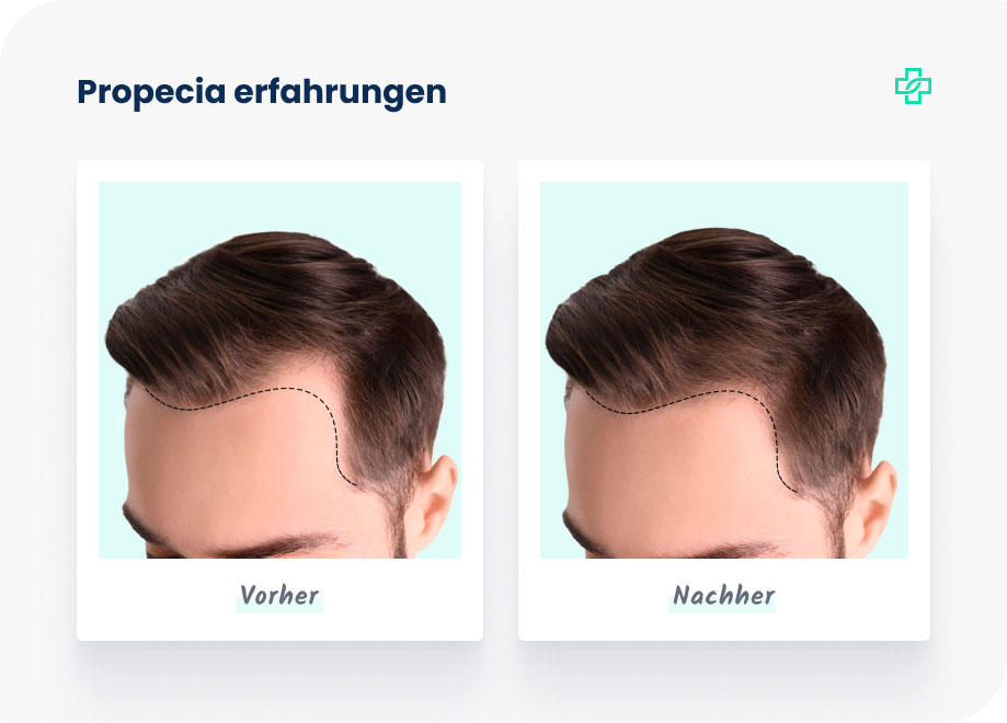 finasteride finpecia 1mg Finasteride Finpecia 1mg