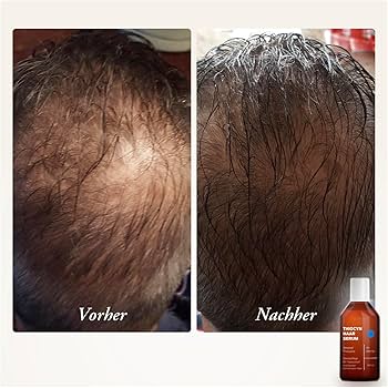 Prix du propecia