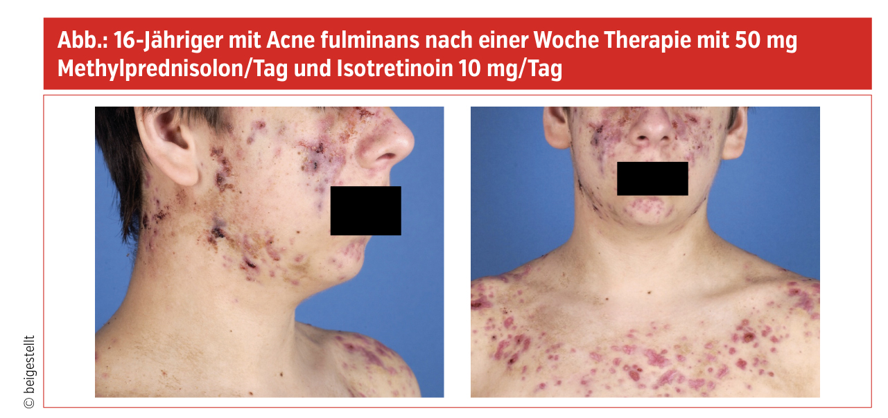 isotretinoin bnf online
