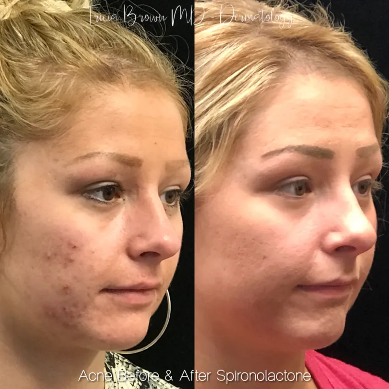 Accutane En Ligne