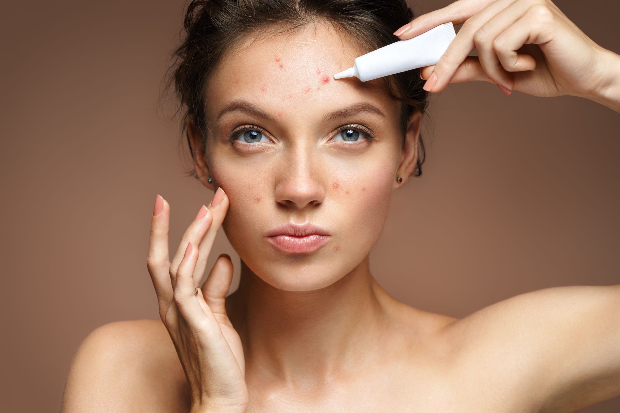 Comment Acheter Du Roaccutane