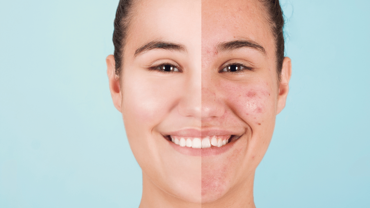 roaccutane sans pilule