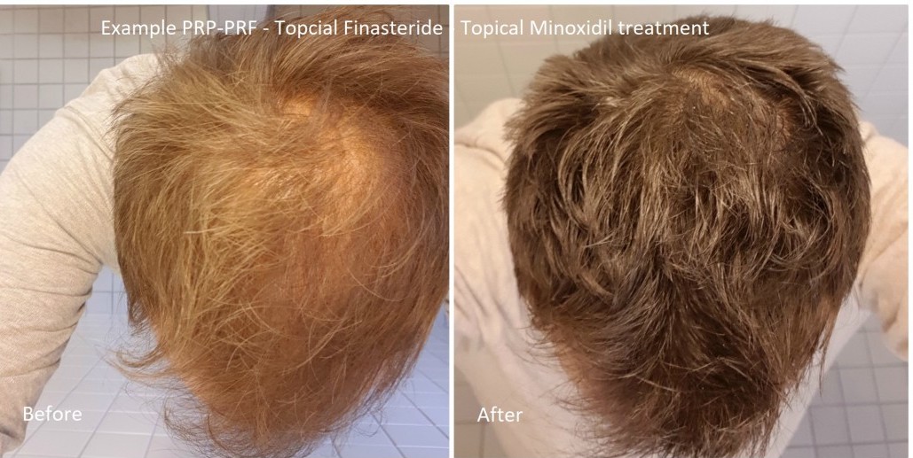 Coût Finasteride