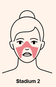 Pilule Apres Roaccutane Pilule apres roaccutane