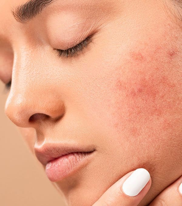 Roaccutane Prix France