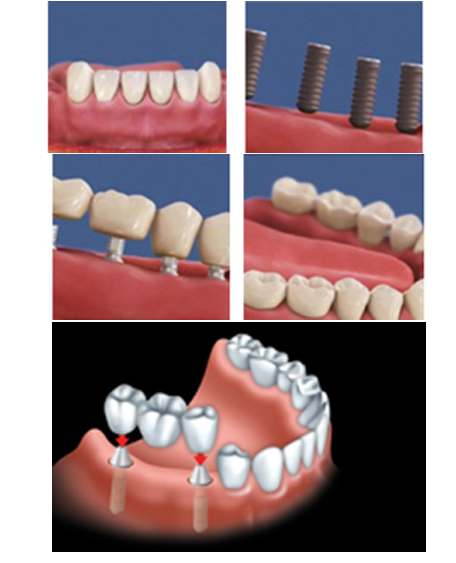 Prednisolone 20 Mg Pour Les Dents