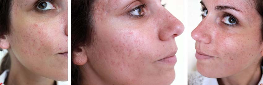 roaccutane gel prix remboursement