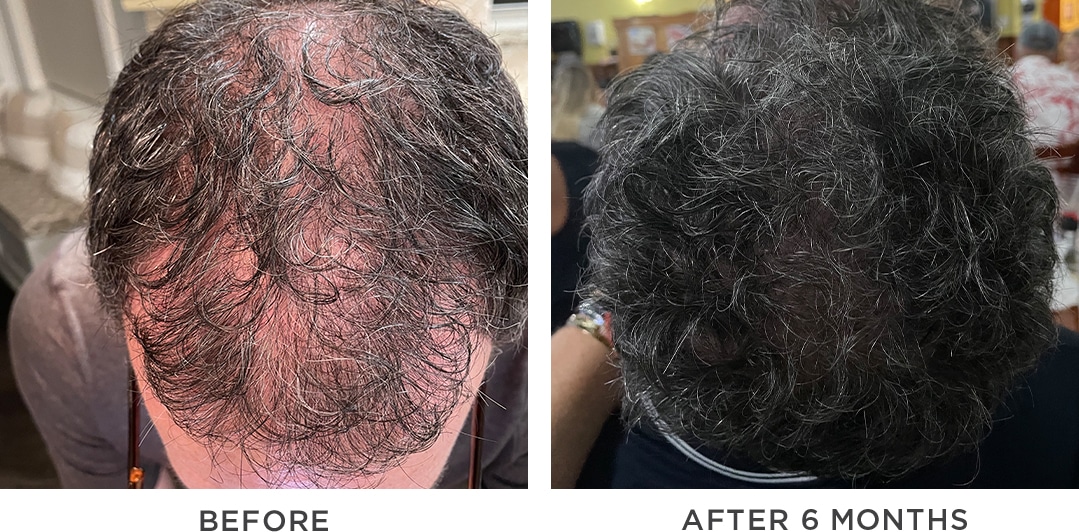 finasteride pas cher