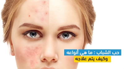 aciclovir opalia prix