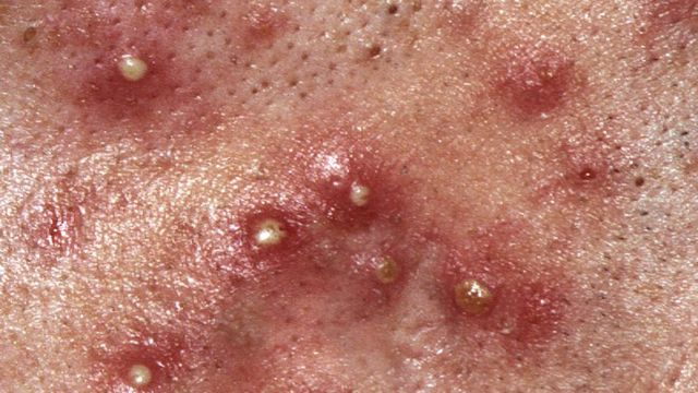 Peut On Avoir Accutane Sans Ordonnance
