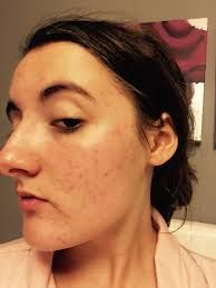 Accutane 30mg Online Accutane 30mg online