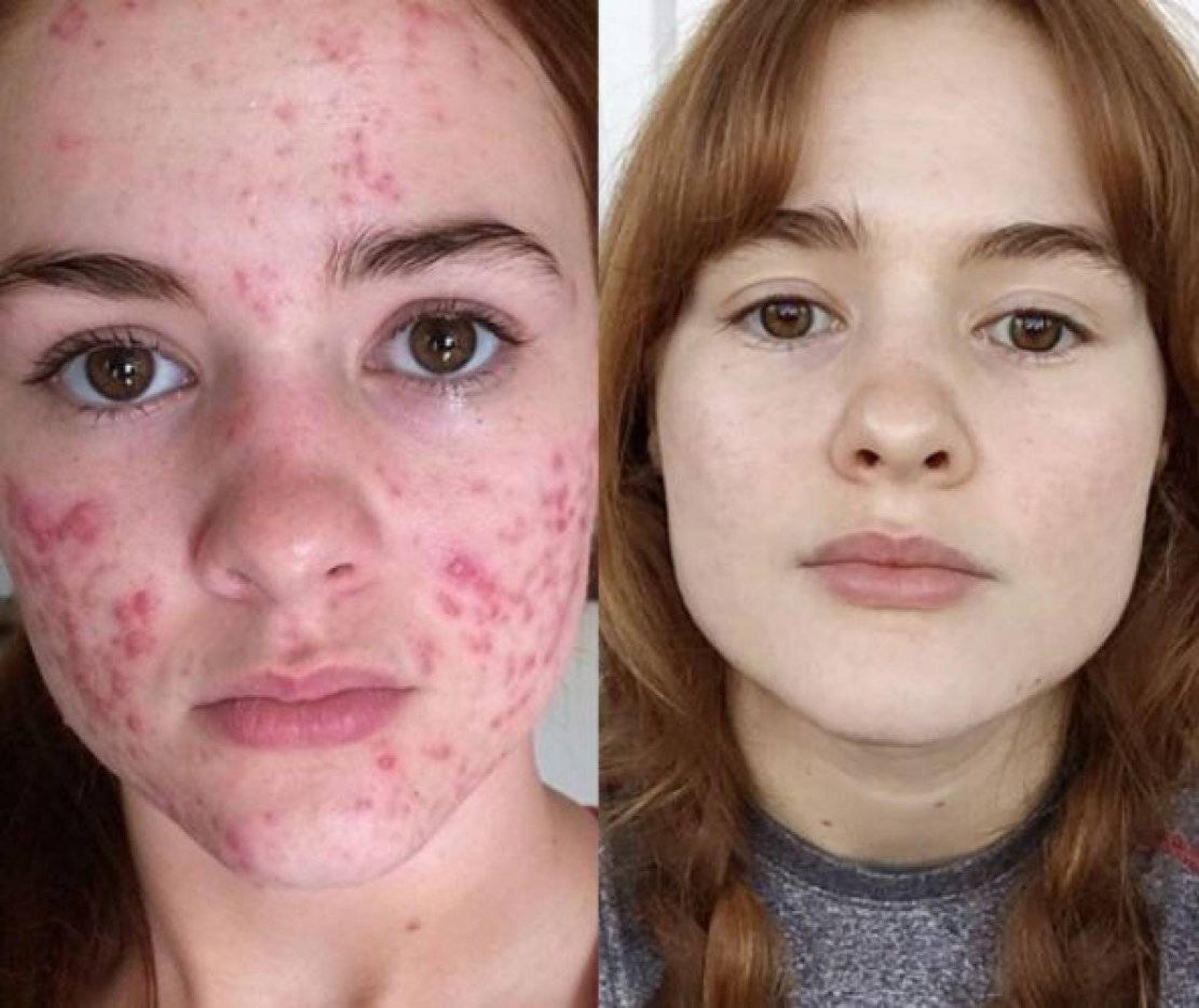 Générique de roaccutane