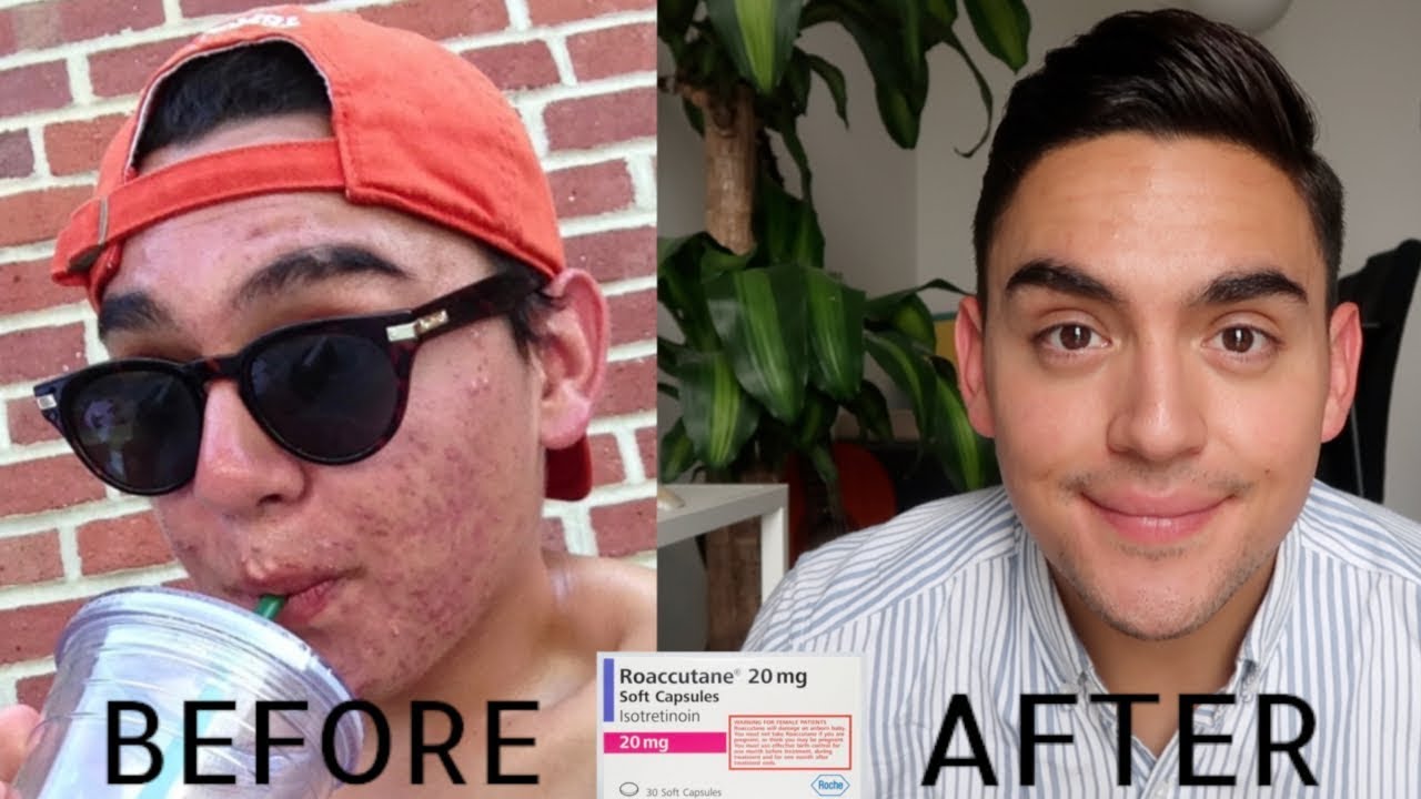 Roaccutane gel achat Roaccutane gel achat