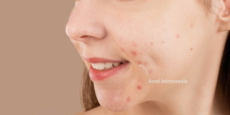 Roaccutane Pilule