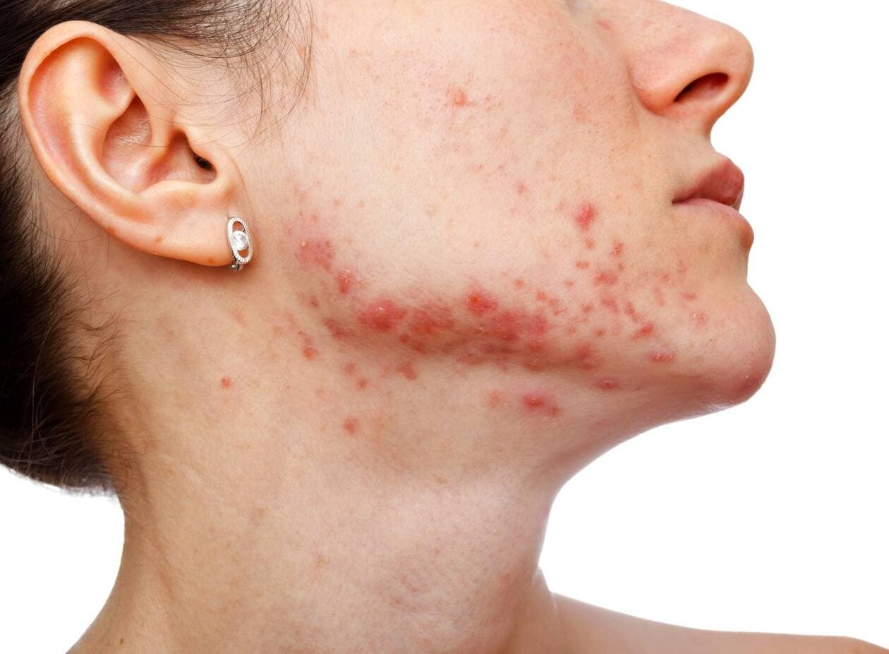 Acheter du roaccutane en ligne Acheter Du Roaccutane En Ligne