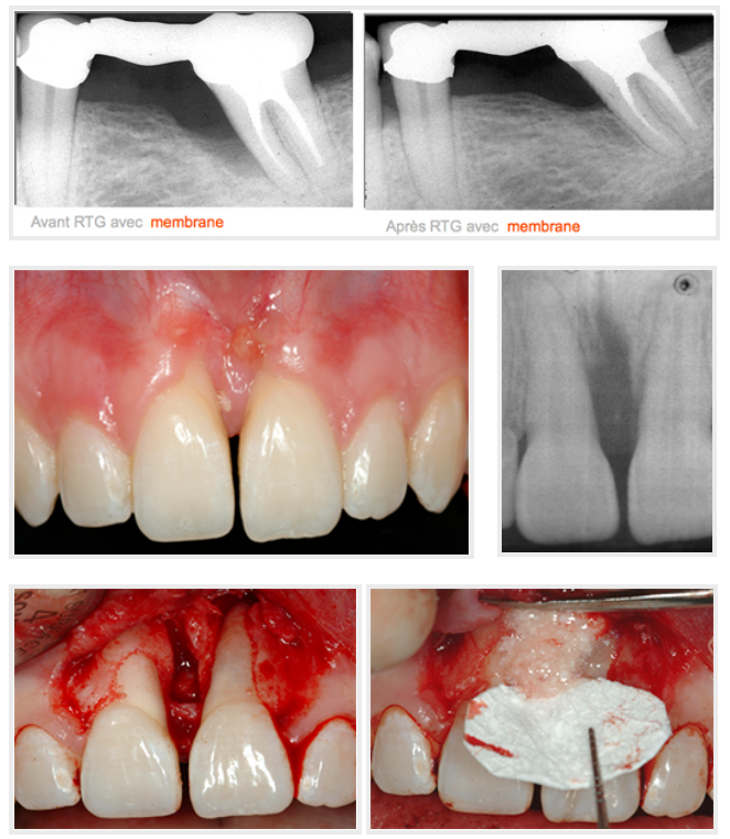 Amoxicilline 500 Mg Pour Les Dents