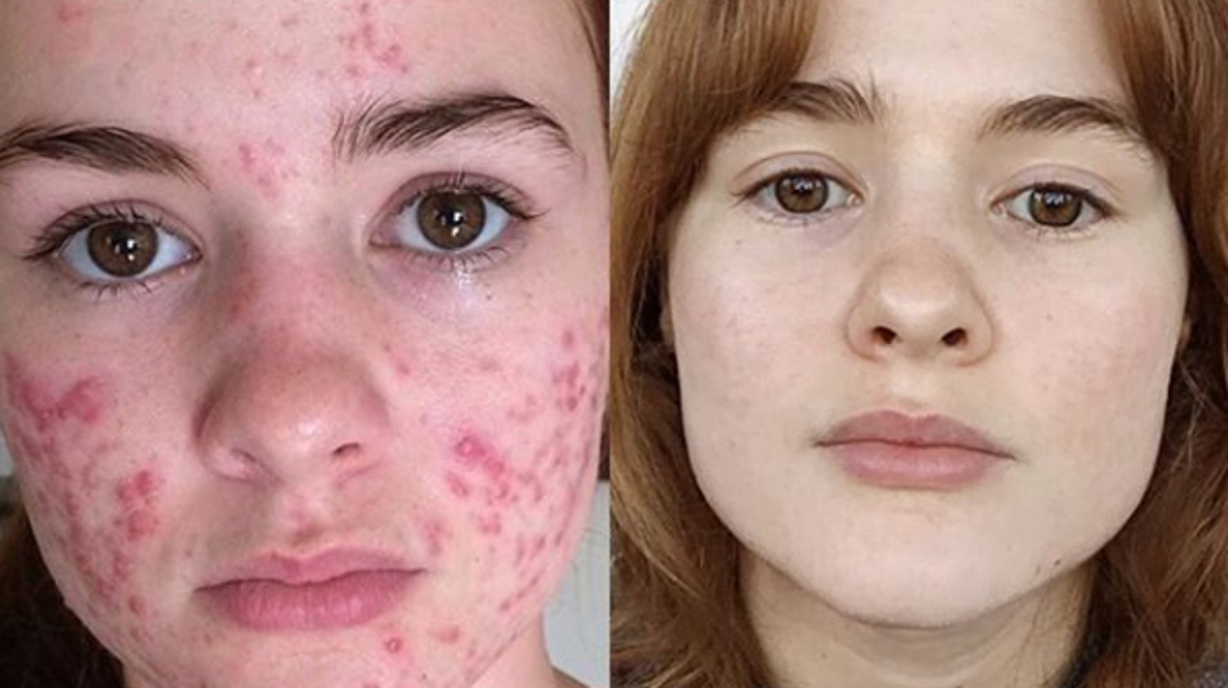 Prix du traitement roaccutane