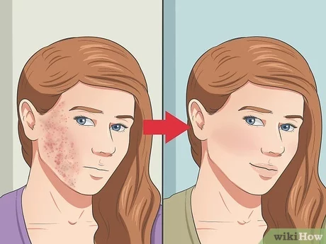 accutane nom generique