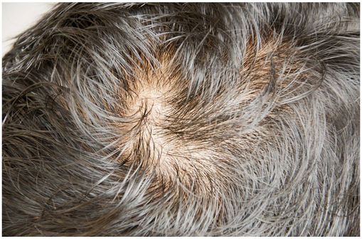 Acheter finpecia en ligne