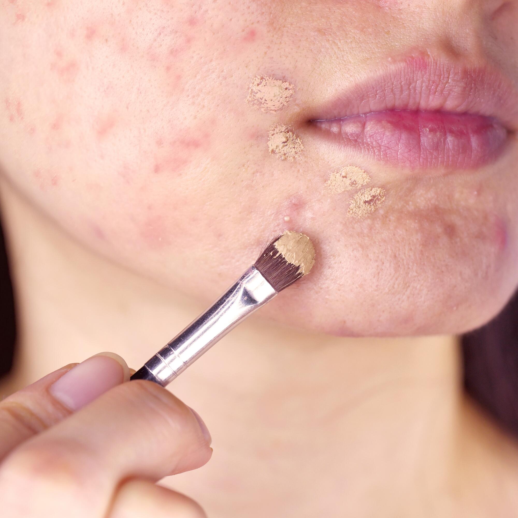 accutane acheter sans ordonnance